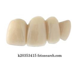 Dental bridge Dental bridge