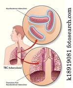 tuberculose