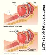 obstructive sleep apnea obstructive sleep apnea