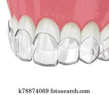 3d render of upper jaw with invisalign removable retainer 3d render of upper jaw with invisalign removable retainer