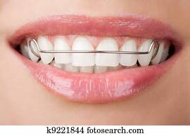 teeth with retainer teeth with retainer
