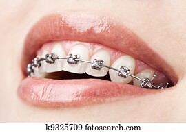 teeth with braces