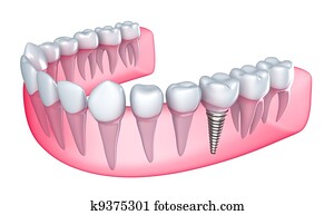 dental, implante, em, a, gengiva