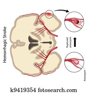 Brain hemorrhagic stroke, eps10 Brain hemorrhagic stroke, eps10