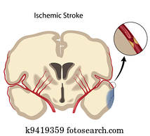 Brain ischemic stroke, eps10 Brain ischemic stroke, eps10