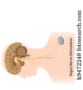 Vagus nerve stimulation therapy Vagus nerve stimulation therapy
