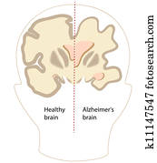 Alzheimer's disease brain, eps8
