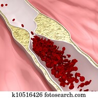 Atherosclerosis disease - plague blocking blood flow Atherosclerosis disease - plague blocking blood flow