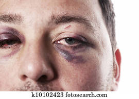 black eye injury accident violence isolated