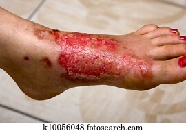 Burn feet Burn feet