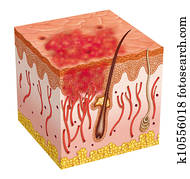 Carcinoma Carcinoma