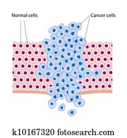 câncer, celas, em, um, crescendo, tumor