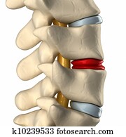 Degenerated disc in spine Degenerated disc in spine