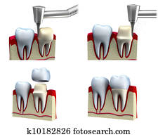 dental, coroa, instalação, processo