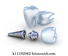 Dental implant and teeth, isolated Dental implant and teeth, isolated