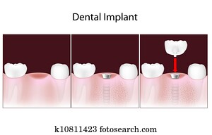 Dental implant procedure, eps10 Dental implant procedure, eps10
