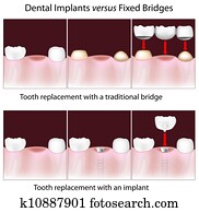 dental, implants, contra, fixo, ponte