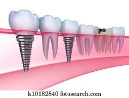Dental implants in the gum Dental implants in the gum