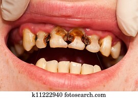 Destructed teeth Destructed teeth