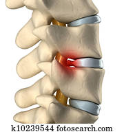 Disc herniated Disc herniated