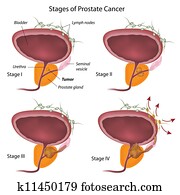fases, de, cancro da próstata, eps10