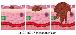 fases, de, um, câncer