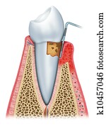 Gingivitis in its second stage Gingivitis in its second stage