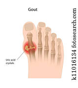 Gout of the big toe, eps10 Gout of the big toe, eps10