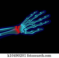 hand, schmerz hand, schmerz