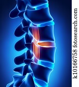 Herniated disc with pressure on spinal cord Herniated disc with pressure on spinal cord