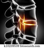 Herniated disc with pressure on spinal cord close-up Herniated disc with pressure on spinal cord close-up