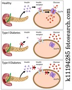 Insulin action & diabetes types Insulin action & diabetes types