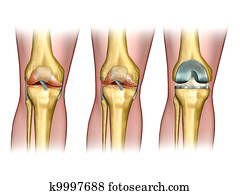 Knee replacement Knee replacement