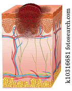 melanoma melanoma