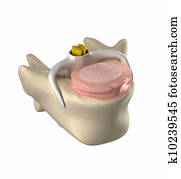 Normal intervertebral disc, spinal cord and nucleus pulposus Normal intervertebral disc, spinal cord and nucleus pulposus