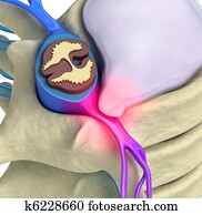 Prolapse of intervertebral disc Prolapse of intervertebral disc