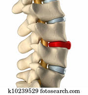 Ruptured disc in lateral view Ruptured disc in lateral view