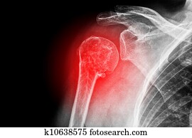 Sore shoulder Sore shoulder