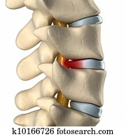 Spinal cord under pressure of bulging disc Spinal cord under pressure of bulging disc