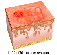 squamous cell carcinoma squamous cell carcinoma