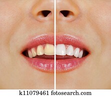 teeth before and after whitening teeth before and after whitening