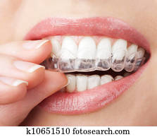 teeth with whitening tray teeth with whitening tray