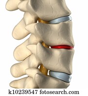Thinning disc Thinning disc