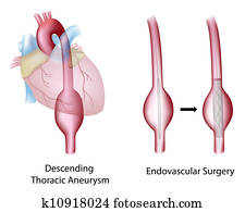 Thoracic aortic aneurysm , surgery Thoracic aortic aneurysm , surgery