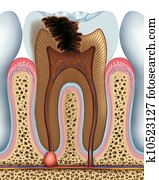 Tooth caries Tooth caries