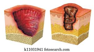 ulceration ulceration