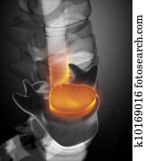 דיסק, הארניאטיון, ב, רנטגן, הבט