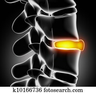 דיסק, קרע, ב, רנטגן, הבט, -, צילום מקרוב