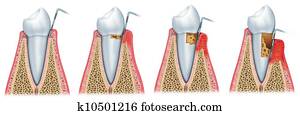התפתחות, של, periodontitis