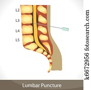 לומברי, puncture.
